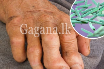 මෙරට ලාදුරු රෝගයේ භයානක තත්වයක් ගැන අනාවරණය වෙයි.