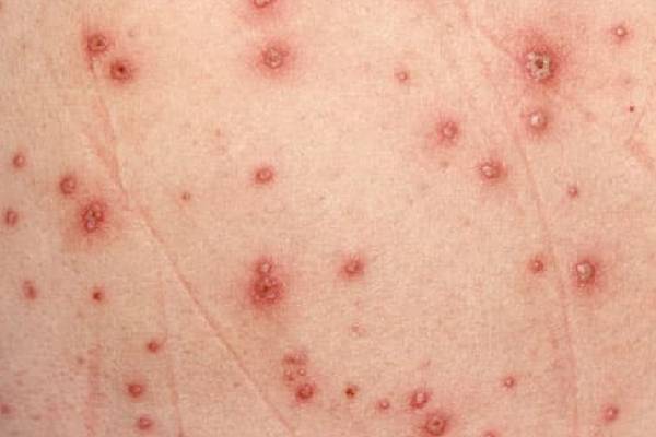 Red Spots on Skin: சருமத்தில் தோன்றும் சிவப்பு புள்ளிகள் ஆபத்தானதா? மருத்துவ விளக்கம் | Whats The Reson Behaind Red Spots On Skin