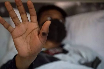 இந்த நான்கு விடயங்களால் குரங்கம்மை பாதிப்பை தவிர்க்கலாம்: பொதுமக்களுக்கு வலியுறுத்தல்