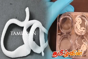இலங்கையில் முதல் முறையாக சிறுவனின் வயிற்றில் மிக நீளமான நாடாப்புழு கண்டுபிடிப்பு