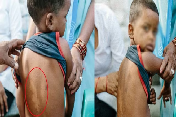 2036 ஆம் ஆண்டுக்குள் நிர்ணயிக்கப்பட்ட இலக்கு | Eliminate Leprosy From The Country By 2036