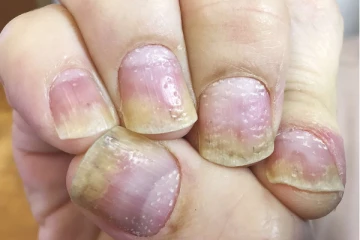 கால்களில் நகம் பார்ப்பதற்கு சொத்தை போல் இருக்கிறதா? உடனடியாக இதை பண்ணுங்க