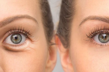 கண்ணுக்கு கீழ சுருக்கமா? இதனை போக்க என்ன பண்ணலாம்?