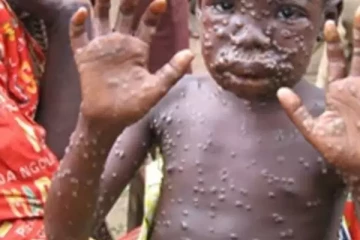 பெரும் அச்சுறுத்தலாக மாறியுள்ள குரங்கு அம்மை - இலங்கையர்களுக்கு விடுக்கப்பட்டுள்ள எச்சரிக்கை