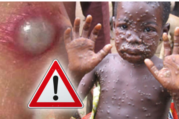கனடா, அமெரிக்கா உள்ளிட்ட 20 நாடுகளை துரத்தும் புதிய தொற்று | Monkey Box Virus Uk Canada Us