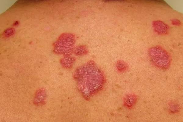 Red Spots on Skin: சருமத்தில் தோன்றும் சிவப்பு புள்ளிகள் ஆபத்தானதா? மருத்துவ விளக்கம் | Whats The Reson Behaind Red Spots On Skin