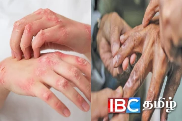 இலங்கையில் மாவட்டமொன்றில் அதிகரிக்கும் தொழுநோய்