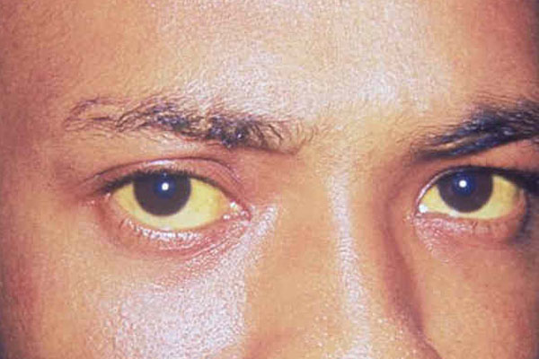 மஞ்சள் அதிகமாக உட்கொள்வதால் இத்தனை ஆபத்துகளா? | So Many Dangers Of Consuming Too Much Turmeric