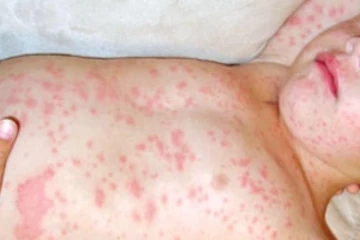 හිස එස වූ සරම්ප - කුඩා දරුවන් 13ක් ජිවිතක්ෂයට..