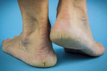 பாதங்களில் உள்ள வெடிப்பைப் போக்கி அழகாக மாற்ற வேண்டுமா? இதோ சில எளிய வழிகள்