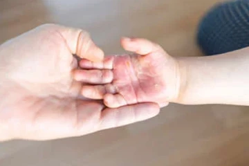 தீக்காயம் ஏற்பட்டால் உடனே இந்த தவறை மட்டும் செய்யாதீங்க...