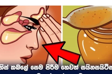 හිස්‌ කබලේ සෙම පිරීම සුව කර ගන්නා ක්‍රම