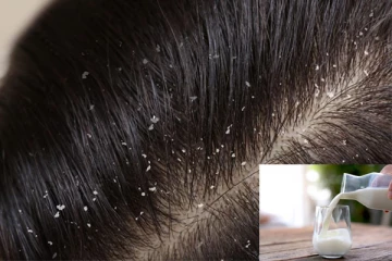 Dandruff: பொடுகு தொல்லையை அடியோடு நீக்கும் பால்; எப்படி பயன்படுத்தலாம்?