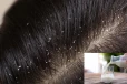 Dandruff: பொடுகு தொல்லையை அடியோடு நீக்கும் பால்; எப்படி பயன்படுத்தலாம்?