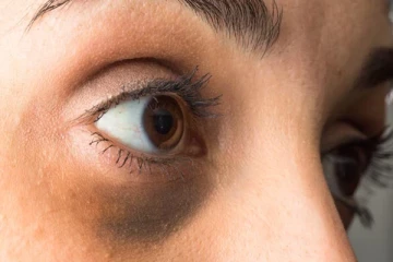 கண்களுக்கு கீழ் கருவளையமா? கவலைய விடுங்க