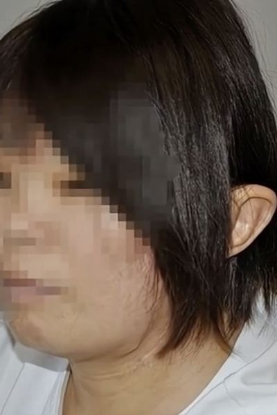 இளம்பெண்ணின் காதை காலுடன் இணைத்து தைத்த மருத்துவர்கள்: ஒரு சுவாரஸ்ய செய்தி | Women Ear Torn Off In Accident Attached In Foot இளம்பெண்ணின் காதை காலுடன் இணைத்து தைத்த மருத்துவர்கள்: ஒரு சுவாரஸ்ய செய்தி | Women Ear Torn Off In Accident Attached In Foot