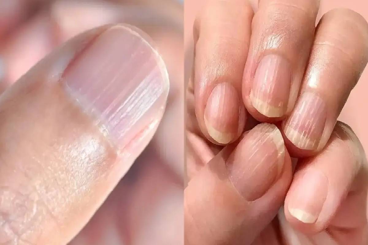 நகங்களில் நேரான புடைப்பான கோடுகள் இருக்கிறதா?இது வருவதன் காரணம் என்ன? | What Causes Straight Raised Lines On Nails