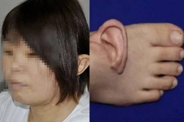 இளம்பெண்ணின் காதை காலுடன் இணைத்து தைத்த மருத்துவர்கள்: ஒரு சுவாரஸ்ய செய்தி