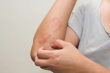 ஒவ்வாமை காரணமாக உயிரிழந்த பாடசாலை மாணவி