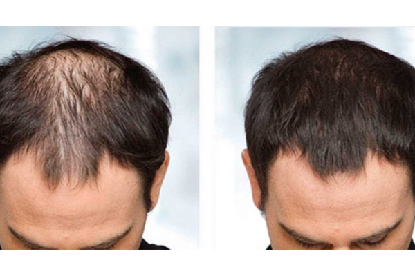 ஆண்களே வழுக்கை விழுகிறது என்ற கவலையா? மறக்காம இதை மட்டும் செய்திடுங்கள் | Hair Growth Mens In Tamil