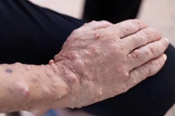 இலங்கையில் கணக்கில்கொள்ளப்படாத ஆபத்தான நோய்! - வைத்தியர் விடுத்துள்ள எச்சரிக்கை