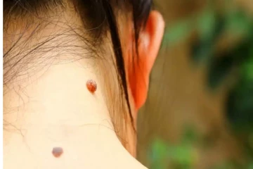 அசிங்கப்படுத்தும் மருக்களை அடியோடு அகற்ற இந்த ஒரு துளி சாறு போதும்.... இனி எட்டி கூட பார்க்காது?