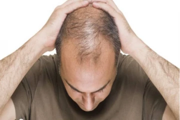 வழுக்கையை கேலி செய்பவர்களுக்கு ஆப்பு வைத்த பிரிட்டன்!