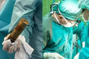 பாலியல் ஆசை .. அந்தரங்க பகுதியில் வெடிகுண்டை சொருகிய முதியவர் - அலறிய மருத்துவர்கள்