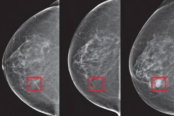 5 ஆண்டுகளுக்கு முன்பாகவே மார்பக புற்றுநோயை கண்டறியும் AI Technology!