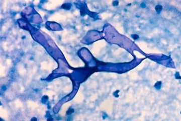 கறுப்பு பூஞ்சை பரவல் - சுகாதார அமைச்சு விடுத்துள்ள அறிவிப்பு