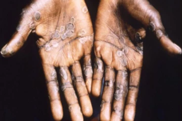 பிரித்தானியாவில் 3 ஆண்டுகள் கழித்து மீண்டும் அரிய நோய் கண்டுபிடிப்பு! 2 பேர் பாதிப்பு