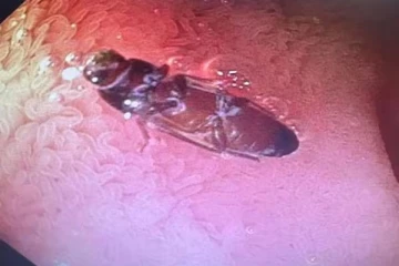 வயிற்றுக்குள் கரப்பான்பூச்சி; அலறிய இளைஞர் - மிரண்ட மருத்துவர்கள்!