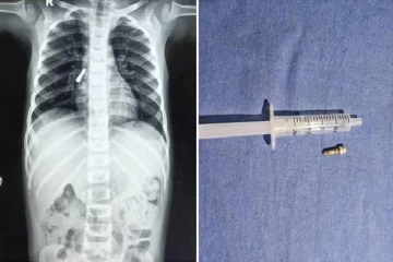 மூச்சுக்குழாயில் சிக்கிய கொலுசு திருகாணி.. தவித்த 3வயது சிறுவன் - அடுத்து நடந்த சம்பவம்!