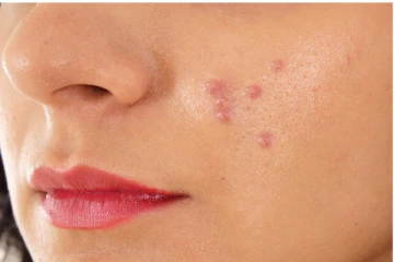 முகப்பரு வராமல் தடுக்க இதை மட்டும் ஒரு முறை செய்து பாருங்க....!