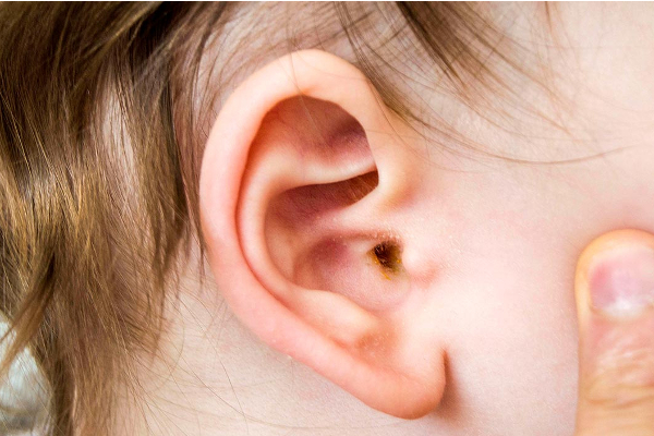 காதில் பட்ஸ் வைத்து சுத்தம் செய்பவரா நீங்கள்? இனி அந்த தவறை செய்திடாதீங்க | Ear Infection Symptoms In Tamil