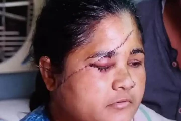 முகத்தில் 118 தையல்.. பாலியல் வன்கொடுமையை தடுத்த பெண் மீது கொடூர தாக்குதல்!