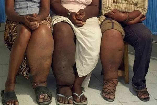 elephantiasis symptoms: யானைக்கால் நோய்... தொற்று நோயா? அறிகுறிகள் எப்படியிருக்கும்? | Elephantiasis Symptoms In Tamil