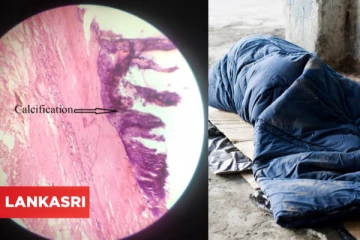 தெருவில் இறந்த நபர்... கல்லாக உறைந்து போன இருதயம்... உடற்கூராய்வில் மருத்துவர்களை அதிர வைத்த சம்பவம்