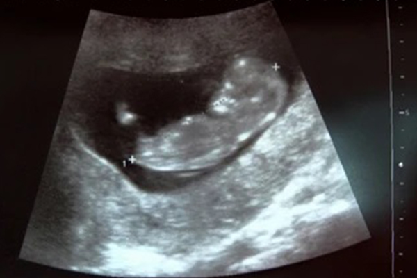 jaffna hospital baby death