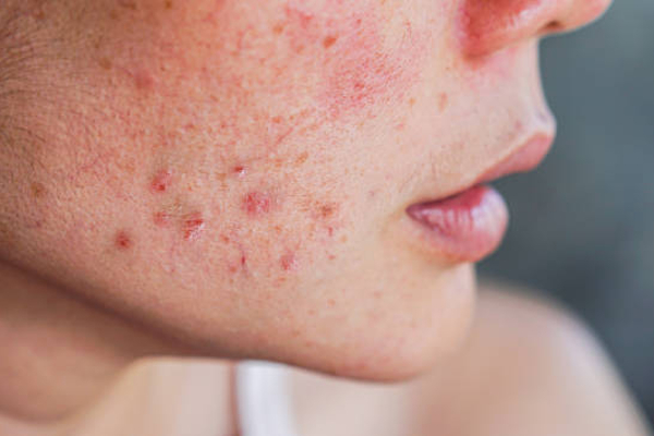 முகப்பரு இல்லாமல் சருமம் பளபளக்கனுமா? இதில் ஒன்றை ட்ரை பண்ணி பாருங்க போதும் | Best Homemade Face Masks For Pimples In Tamil