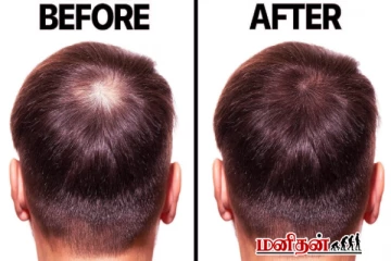 வழுக்கை விழுவதை மாற்றுவதற்கான இயற்கை வழிகள் - வாரம் இரு முறை செய்ங்க