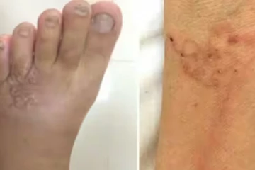 பச்சை ரத்த உணவு சாப்பிட்டதால் காலின் உட்பகுதியில் நெளிந்த புழுக்கள்!