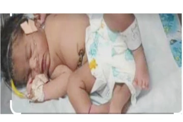 மத்திய பிரதேசத்தில் 4 கால்களுடன் பிறந்த பெண் குழந்தை... - வைரலாகும் புகைப்படம்...!