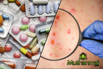 சின்னம்மை நோயிற்கான மருந்து தட்டுப்பாடு இல்லை! வெளியான அறிவிப்பு