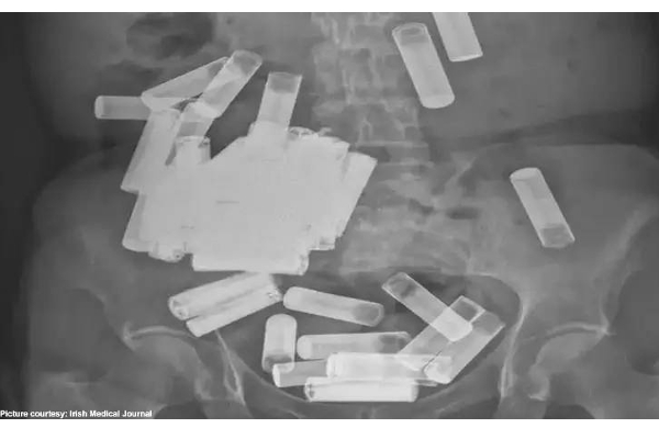55 பேட்டரிகளை விழுங்கிய 65 வயது பெண் - காரணம் என்ன? மருத்துவர்களின் சாதனை! | Womans Gut And Stomach Remove 55 Batteries