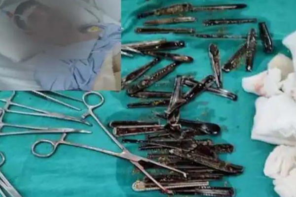 இளைஞரின் வயிற்றில் 63 ஸ்பூன்கள்.. திகைத்து நின்ற மருத்துவர்கள்! வெளியான அதிர்ச்சி காரணம் | Man Stomach 63 Steel Spoon Removed