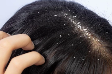 உங்களுக்கு பொடுகு தொல்லை அதிகமா இருக்கா? கவலை விடுங்க.. இதனை போக்க இதோ சில டிப்ஸ்!