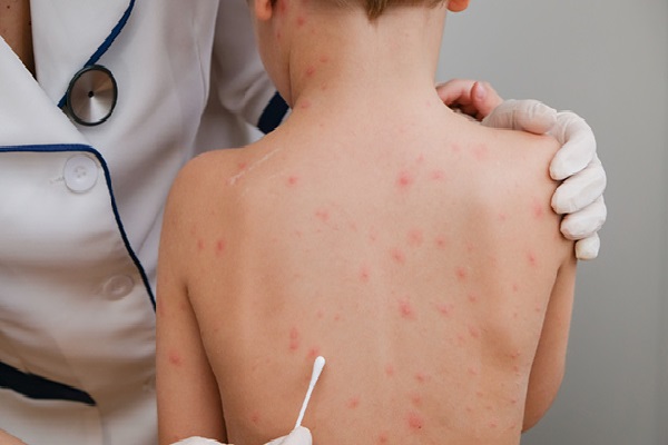 சிறுவர்கள் தொடர்பில் பரப்பப்படும் பொய்யான தகவல்கள் | Skin Disease Does Not Spread Among Children