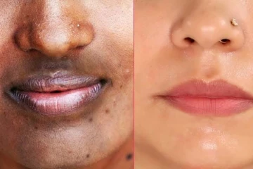 வாயை சுற்றி கருப்பாக உள்ளதா? இதனை எளிய முறையில் போக்க இதோ சில அட்டகாசமான டிப்ஸ்!