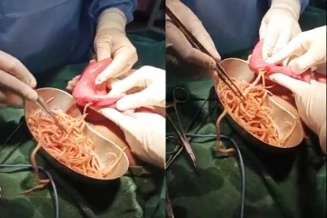 சிறுவனின் குடலில் இருந்து 1 கிலோ புழுக்கள் அகற்றம் - அதிர்ந்து போன மருத்துவர்கள்